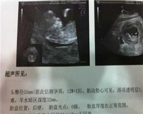 广州试管婴儿助孕,姐妹俩同一天各自生下双胞胎